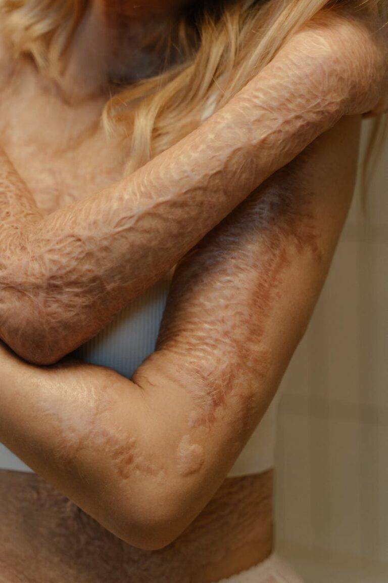 burn scars on a woman s body